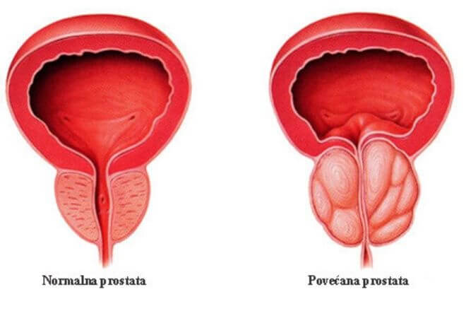 Povećana prostata
