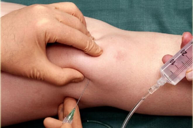 liječenje artroze koljena forum)