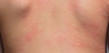 kontaktni alergijski dermatits