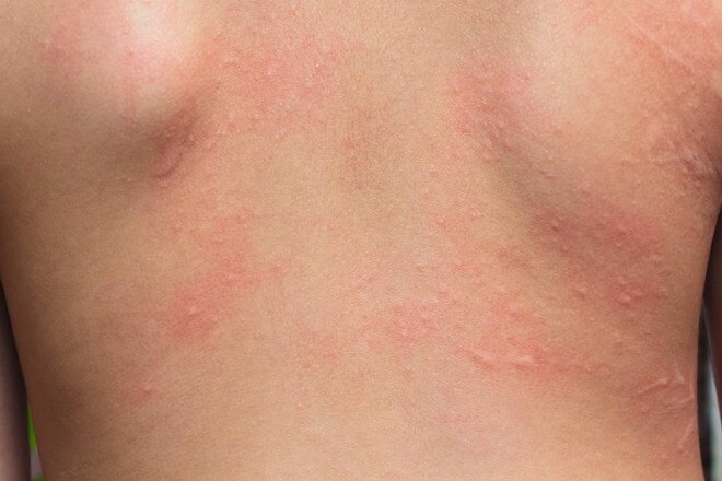 kontaktni alergijski dermatits