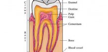 Pulpitis