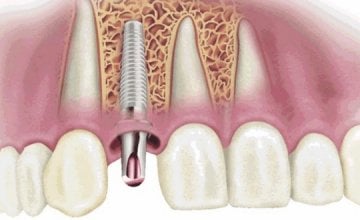 zubni-implantati