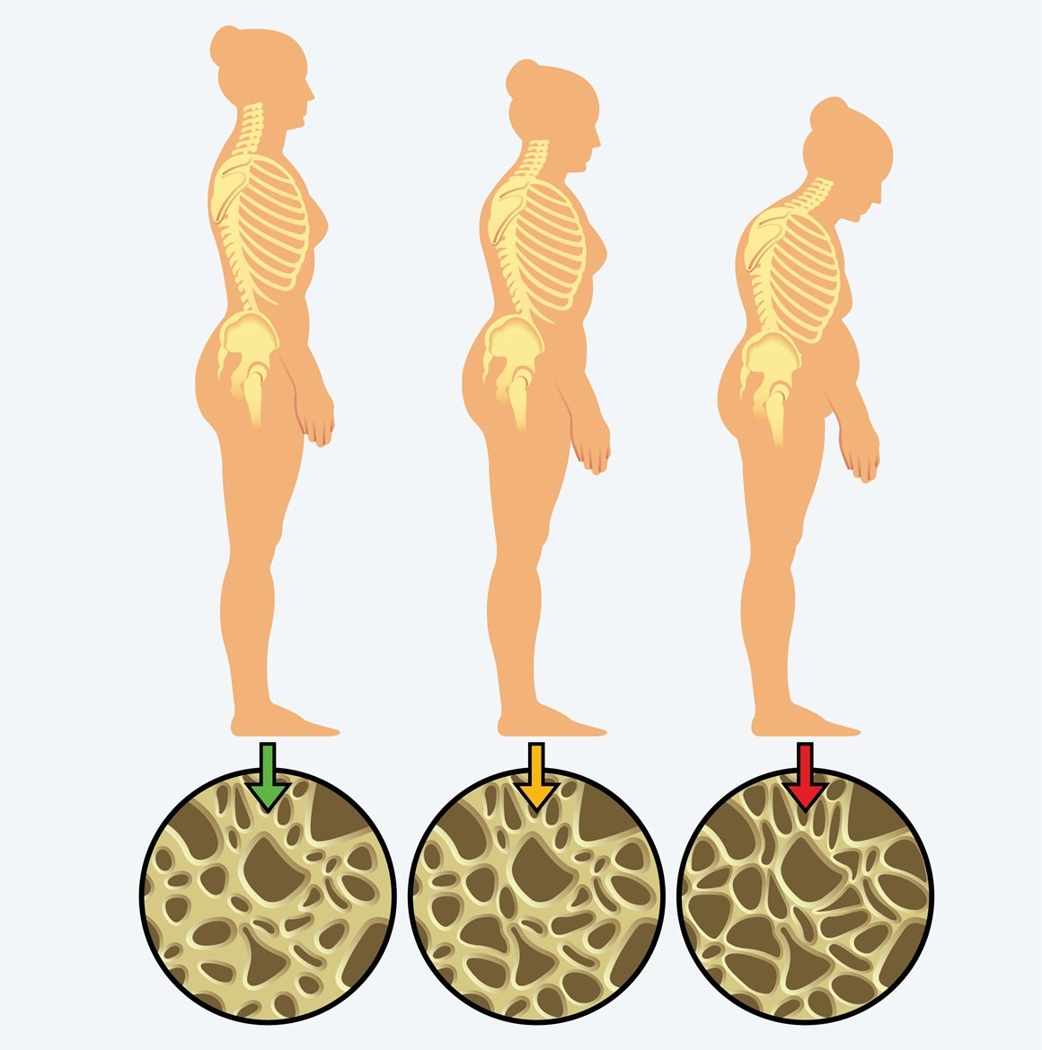 idiopatska osteoporoza