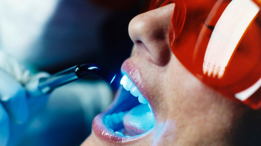 izbjeljivanje zubi