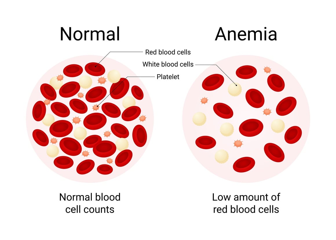 anemija - krvna slika