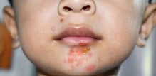 Impetigo