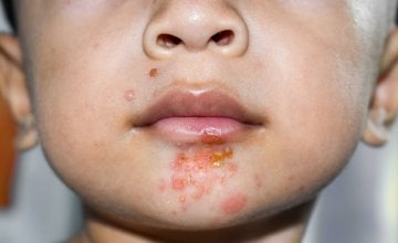 Impetigo