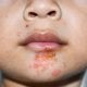 Impetigo