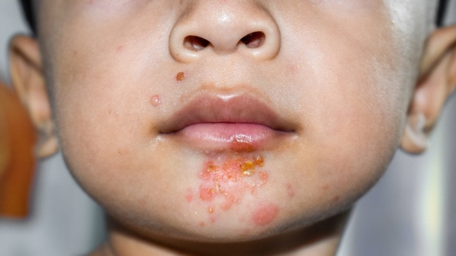 Impetigo