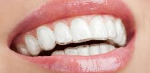 Mobilni (nevidljivi) aparatić - SmileLign clear aligner