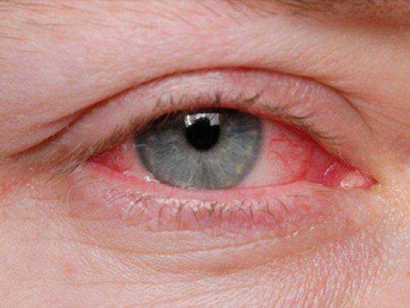 Artritis i oči: kako artritis utječe na vid?