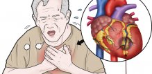 Angina pektoris - uzroci