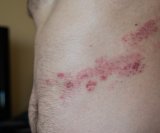 Herpes zoster