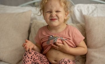 Vodene kozice kod djece