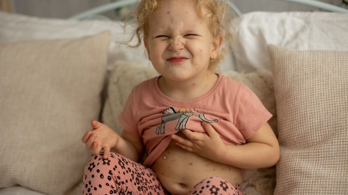 Vodene kozice kod djece