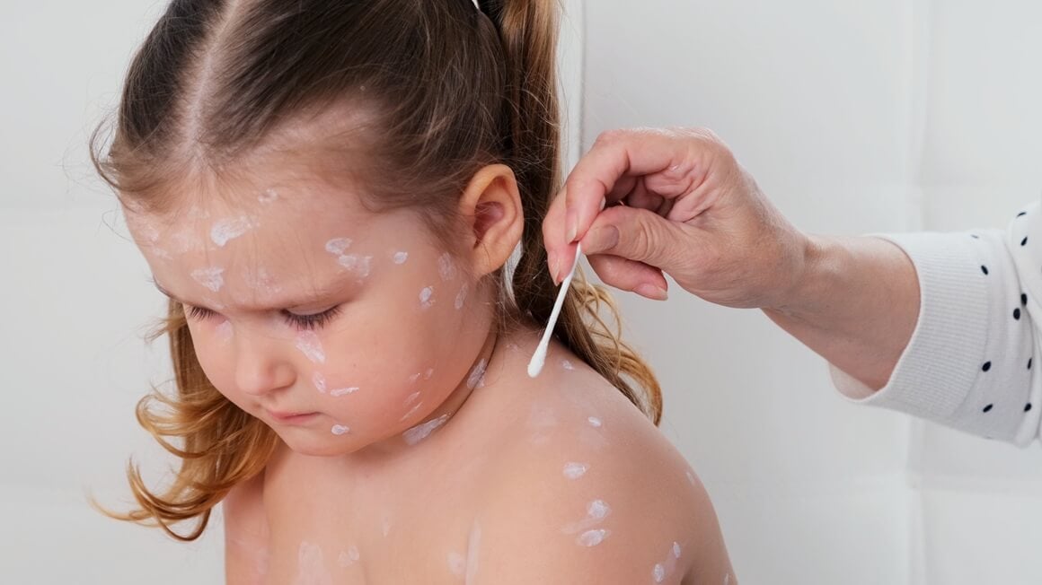 Vodene kozice - liječenje