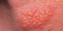 herpes tip 2 genitalije