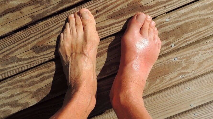 akutna bol u zglobovima stopala grupni vitamini za bolove u zglobovima