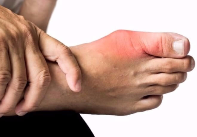 simptomi i liječenje gihta stopala)