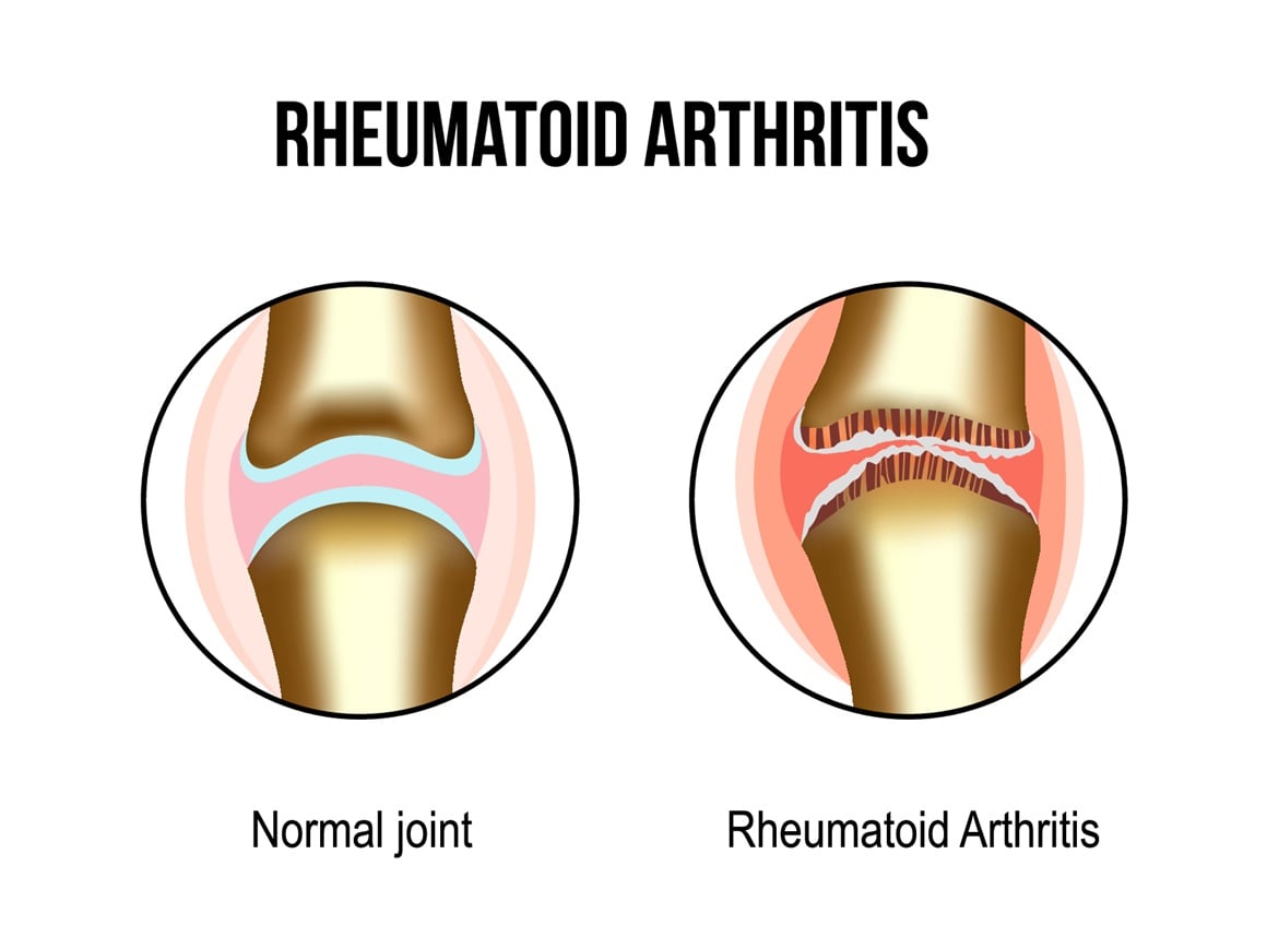 Reumatoidni artritis