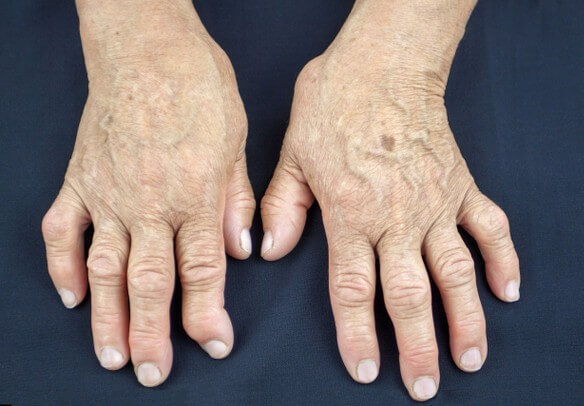 artritis liječenje plava glina)