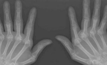 artritis ruku artroza učinkovit tretman uzroci liječenja boli u zglobovima