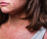 Atopijski dermatitis kod odraslih