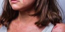 Atopijski dermatitis kod odraslih