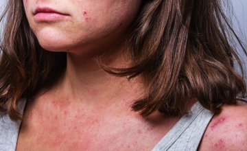 Atopijski dermatitis kod odraslih