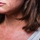 Atopijski dermatitis kod odraslih