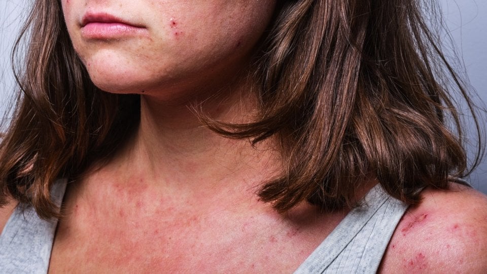 Atopijski dermatitis kod odraslih