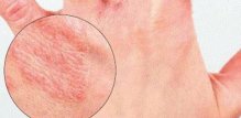 alergijski-dermatitis