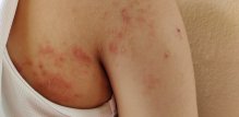 atopijski dermatitis - liječenje