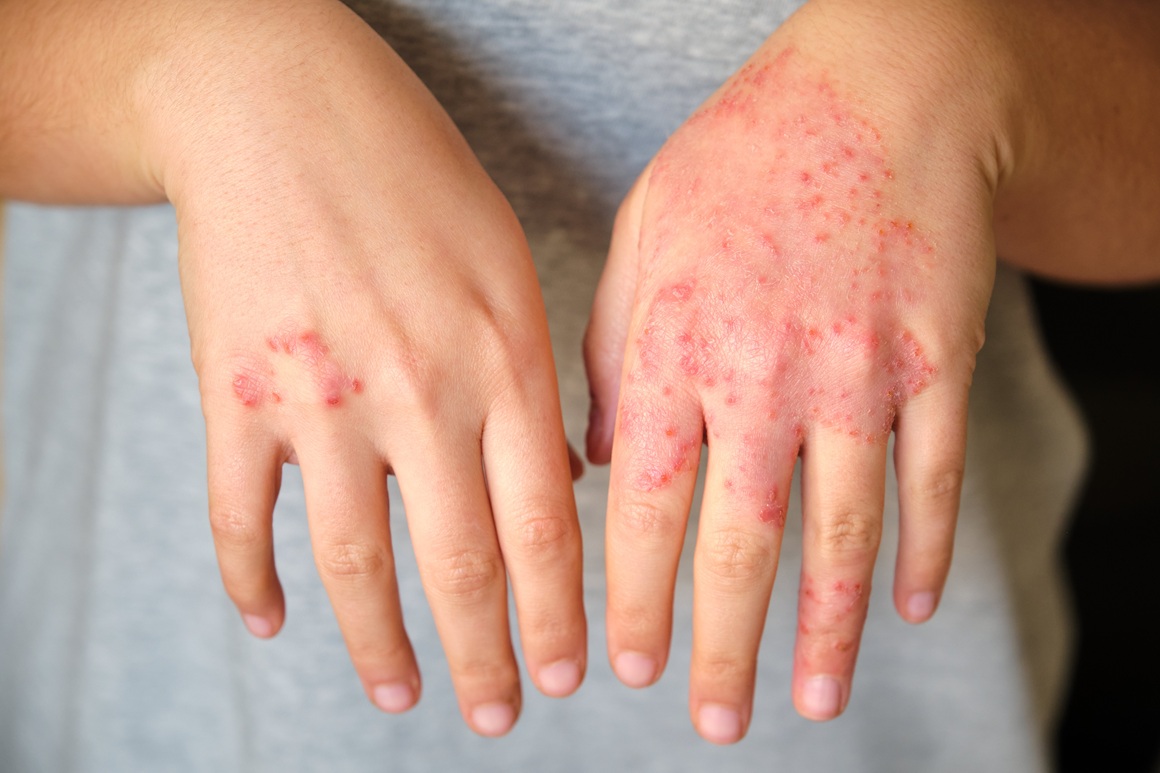 atopijski dermatitis - uzrok