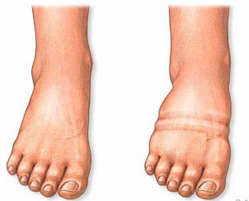 bol u prednjem dijelu stopala stopala zglobova)