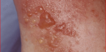 kontaktni dermatitis