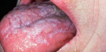 lichen planus