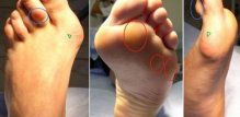 osteoartritis stopala