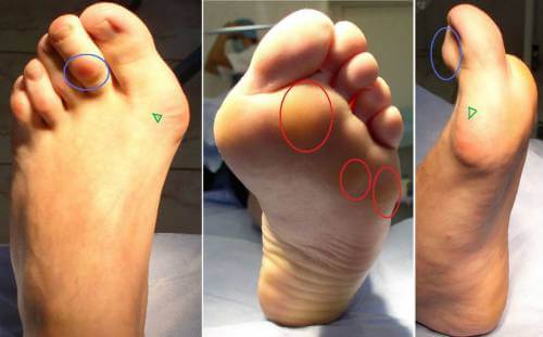 mast za liječenje osteoartritisa stopala)