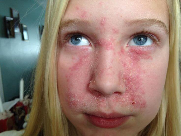 seboroicni dermatitis djeca