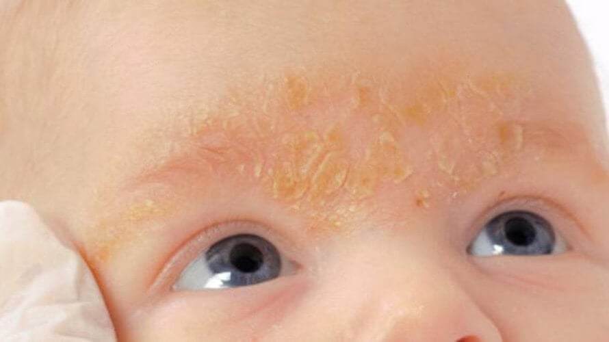 seboroicni dermatitits kod djece