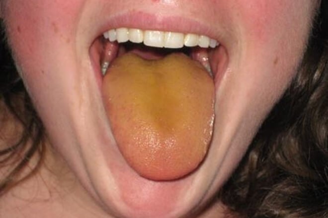 zuti jezik jetra