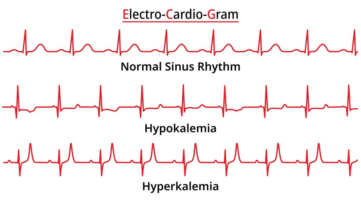 hipokalijemija - EKG