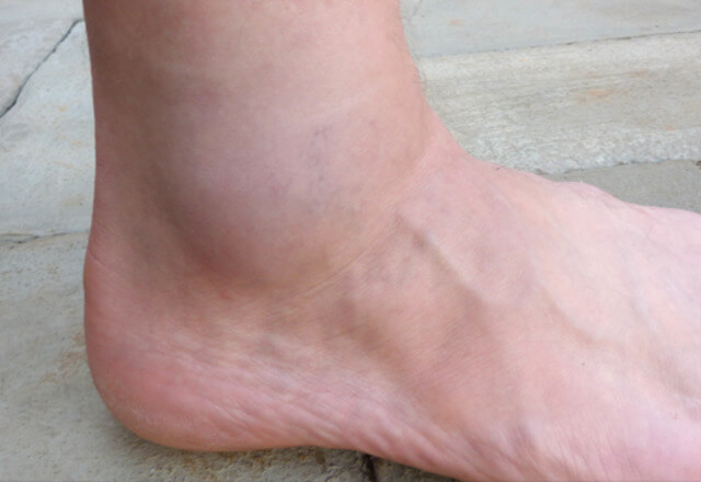 bol u zglobovima stopala i nožnih prstiju