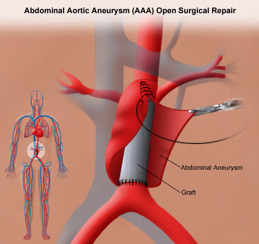 abdominalna aneurizma