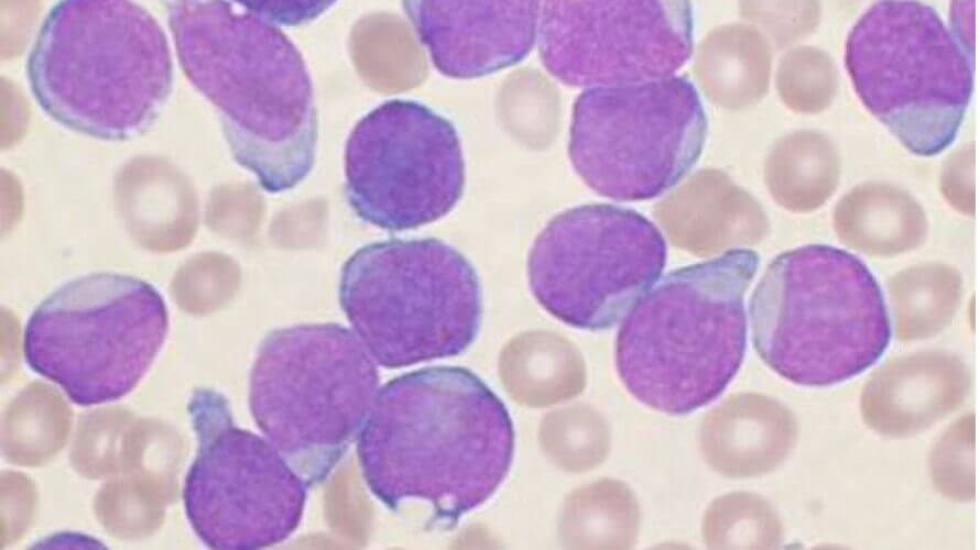 akutna limfocitna leukemija