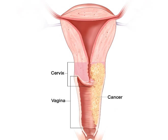 Karcinom-vagine