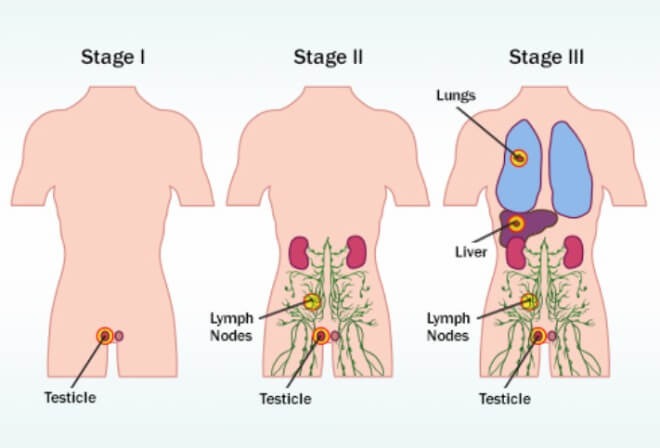 Rak-testisa-stadiji