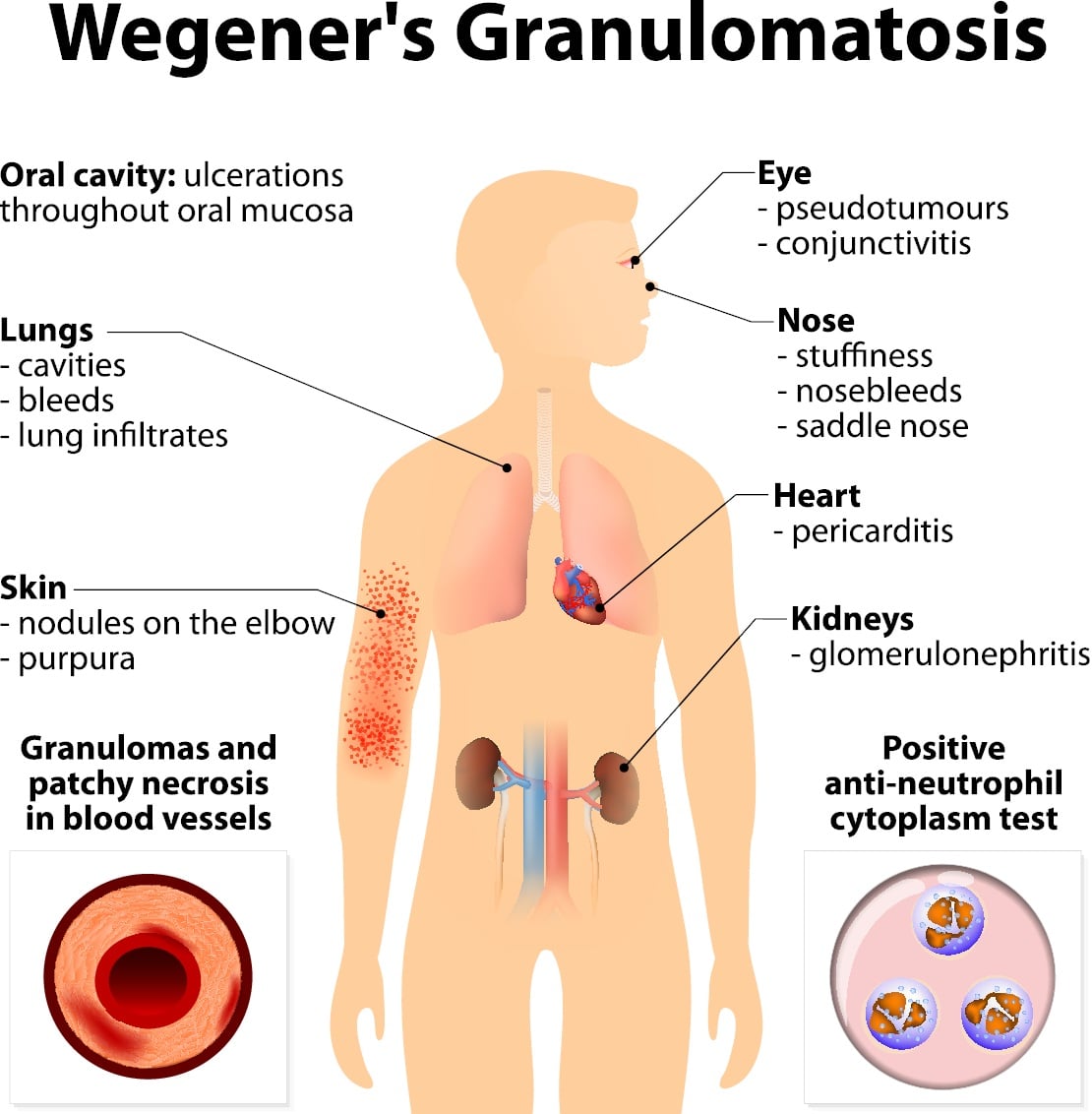 Wegenerova granulomatoza