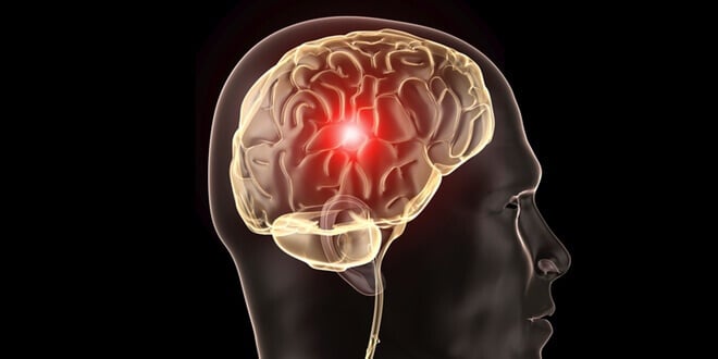 aneurizma mozga